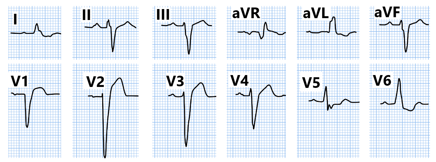 多在150ms~160ms以上时心电图特征才能充分表现;很多同道认为心电向量